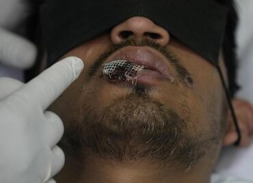 América es ahora epicentro del brote de viruela del mono, dice la OPS