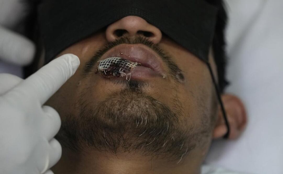 Un médico muestra una llaga de viruela del simio en el labio de un paciente, en el hospital Arzobispo Loayza en Lima, Perú. Foto: AP