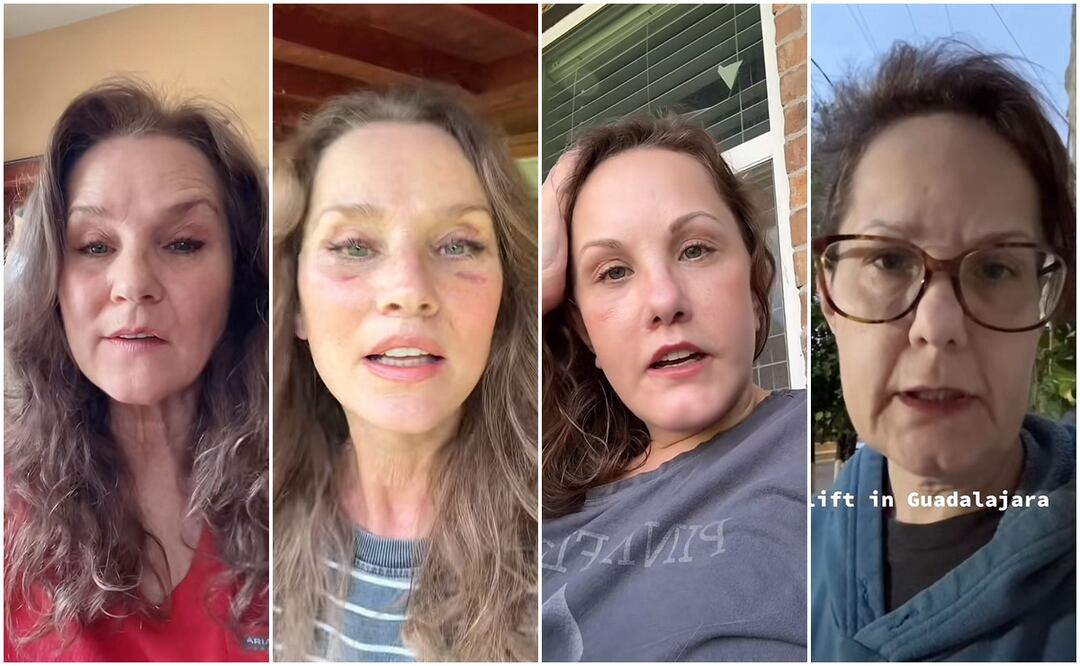 Durante su recuperación, las mujeres comparten la evolución diaria de su rostro. Fotos: Redes Sociales