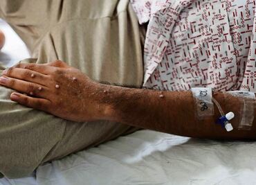 Viruela del Mono: Estudio señala que niños menores de 8 años deberían ser vacunados si se extiende el brote