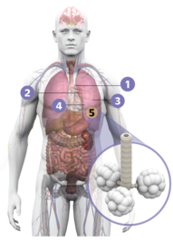 ¿Qué es la neumonía?