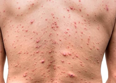 Viruela del mono: México no ha registrado casos de variante letal de Mpox, asegura SSa