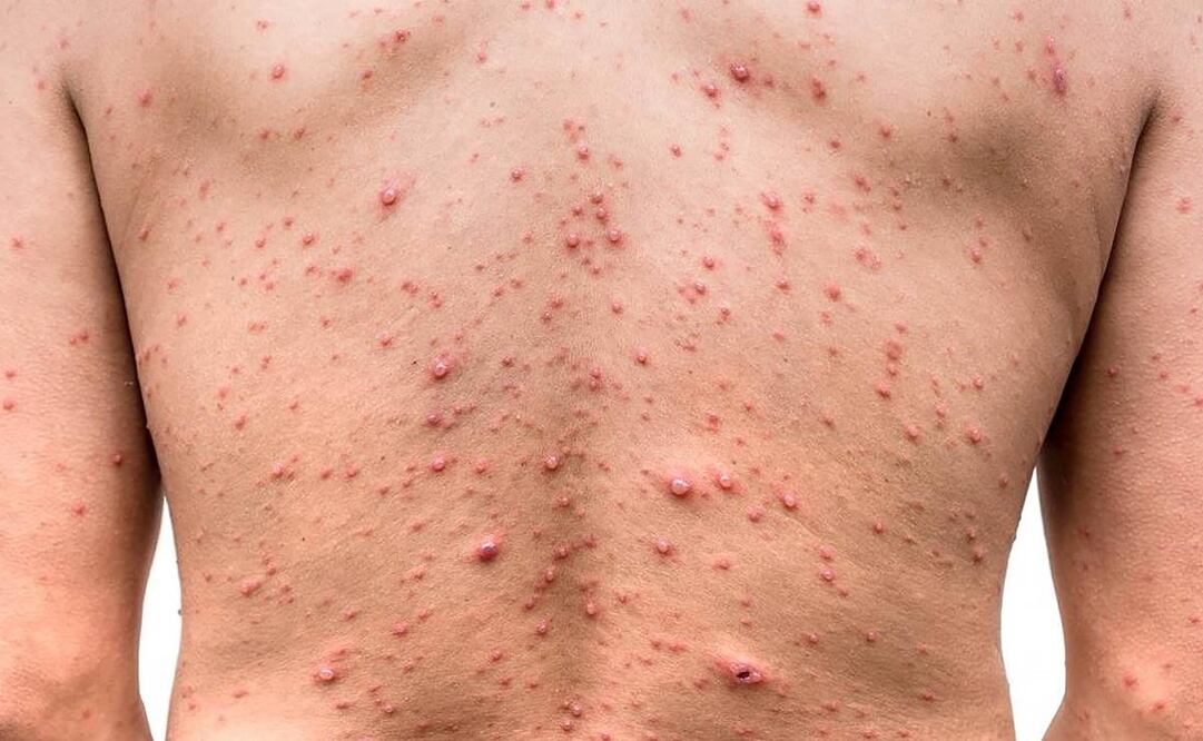 El pasado 14 de agosto, la OMS emitió una emergencia sanitaria y solicitó a los países integrantes reforzar sus sistemas de vigilancia epidemiológica. Foto: EL UNIVERSAL