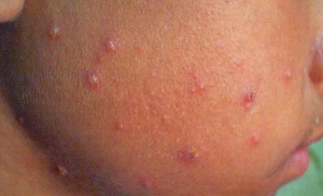 Confirman brote de varicela en primaria de Piedras Negras. Imagen ilustrativa. Foto: Especial