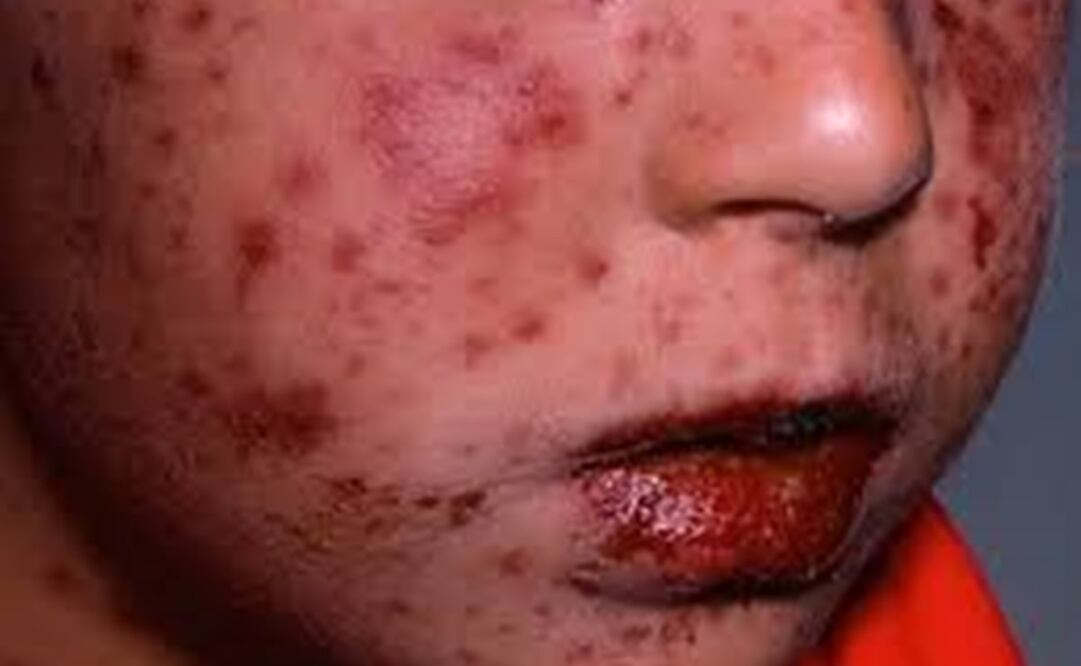 Virus coxsackie. Foto: ARCHIVO