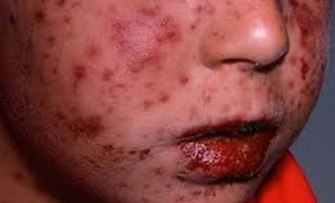 Virus coxsackie. Foto: ARCHIVO