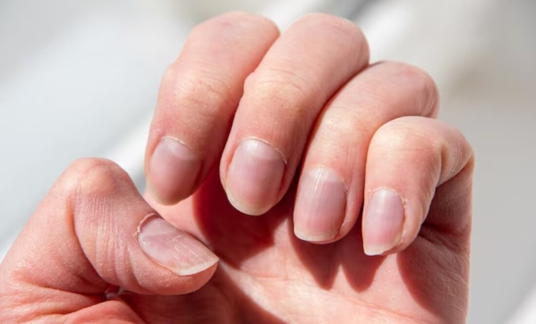 Uñas mordidas. Foto: Freepik