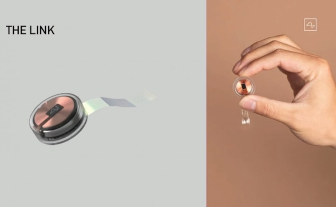 Los chips de Neuralink implantados son diminutos y transmiten señales en tiempo real