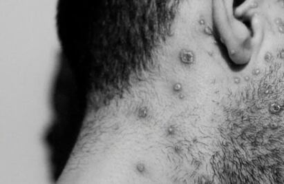 Bélgica reporta primer muerte de un paciente por viruela del mono