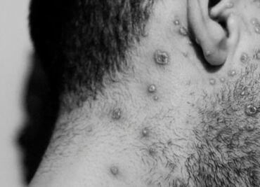 Bélgica reporta primer muerte de un paciente por viruela del mono