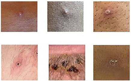 ¿Qué significa que la OMS declare emergencia internacional al brote por la viruela del mono?