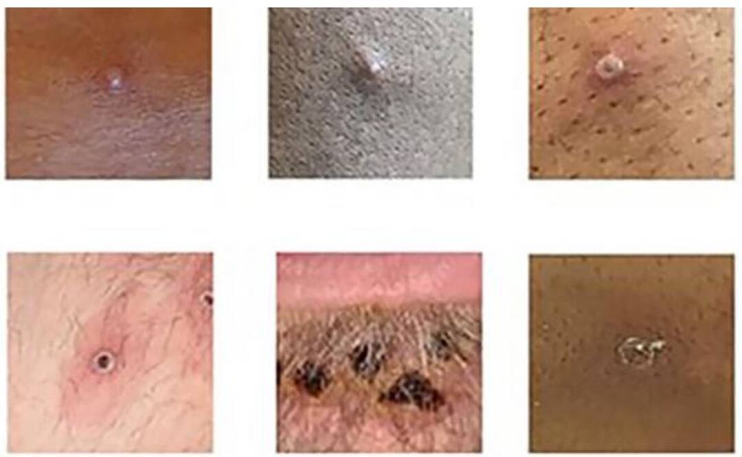 Foto: Especial/El Universal/ El brote de viruela del mono que se expande en más de 70 países