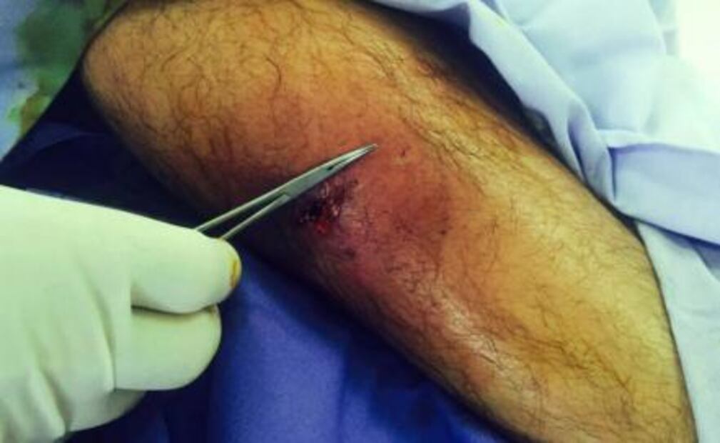 "El Potrillo" fue intervenido por gangrena