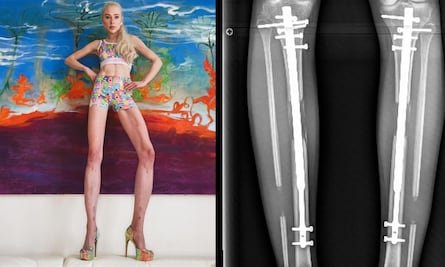 Modelo se somete a cirugías para alargar sus piernas, ¿por qué?