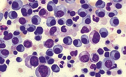 Mieloma múltiple tiene un boom en México