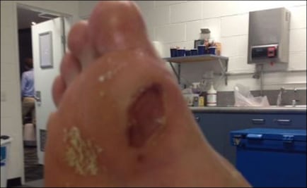 Así terminó el pie de Hyeon Chung después del Australian Open