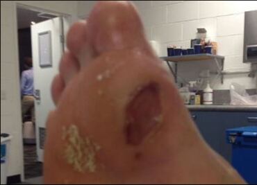 Así terminó el pie de Hyeon Chung después del Australian Open