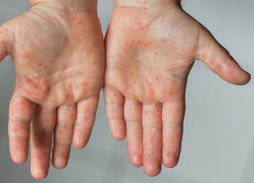 Brote de sarampión en Zimbabwe deja al menos 157 menores muertos