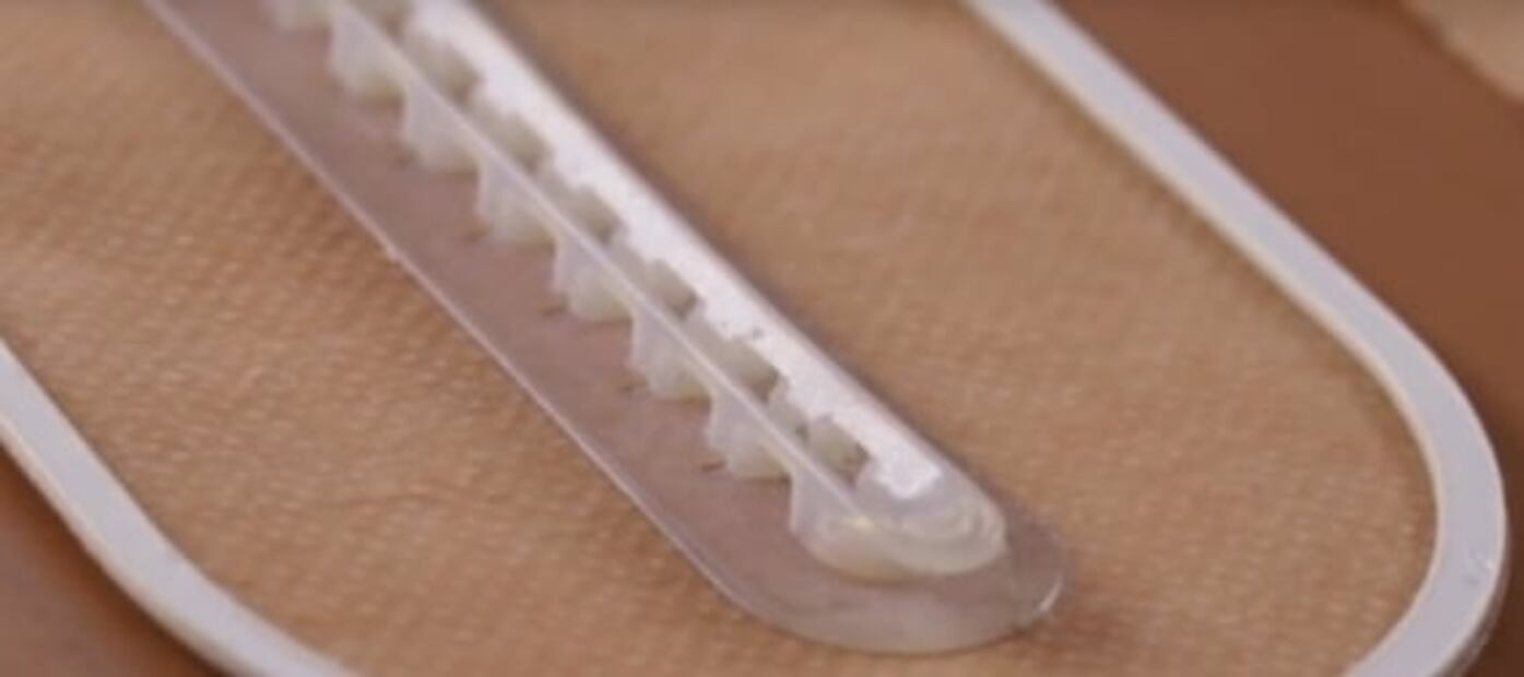 Parche autoadhesivo, la nueva forma de cerrar heridas sin sutura
