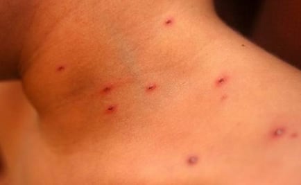 Alertan por brote de varicela en estación migratoria en Chiapas