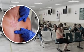 Sarampión en México: ¿cuáles son los principales síntomas de la enfermedad?; conoce el tratamiento eficaz