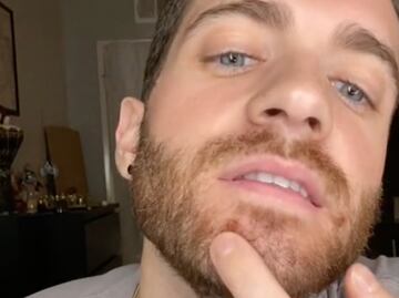 Tiktoker narra su experiencia al contraer la viruela del mono