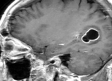 Implante bilingüe: Chip con IA permite a paciente con parálisis cerebral comunicarse en inglés y español