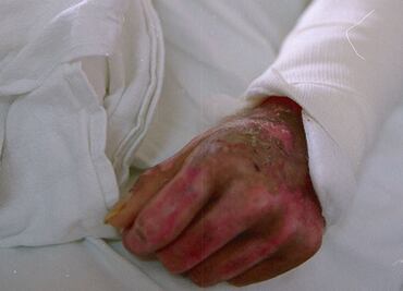 Diputada del PT propone hasta 15 años de cárcel a quien cause lesiones con ácidos