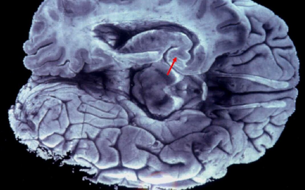 Esta parte del cerebro es la encargada de procesar el miedo y la mayor parte de las emociones de carga negativa como la ira. FOTO: Archivo/ EL UNIVERSAL