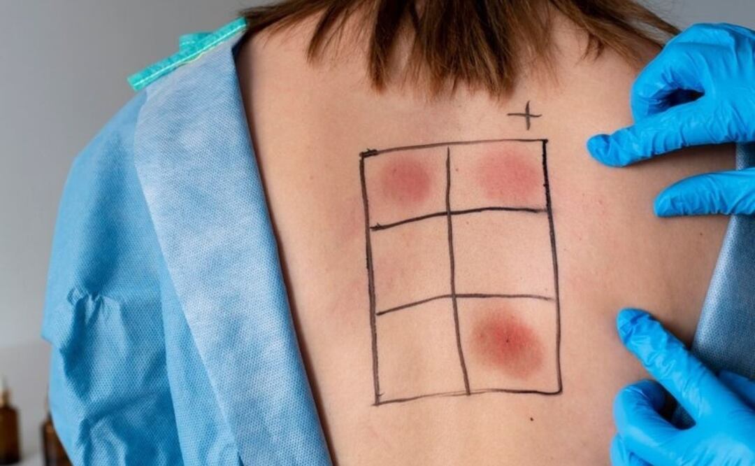 Árnica contra los hematomas. Fuente: Freepik