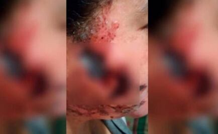 Vinculan a proceso a sujeto que echó ácido a ex novia