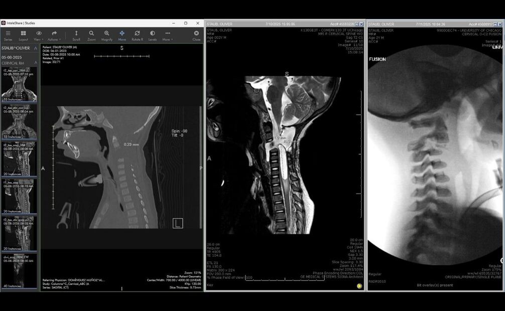 Radiografías de las lesiones de Oliver Staub previo a su intervención quirúrgica en Chicago. De lado izquierdo se aprecia la separación entre las cervicales del menor y el resto de su columna. Foto: Cortesía Dr. Mohamad Bydon.