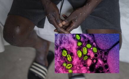 La OMS advierte probabilidad de nuevos brotes de mpox en Europa, tras detección de caso en Suecia