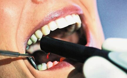 Patógenos de la boca provocan un cáncer oral muy agresivo