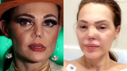 ¡SORPRENDENTE! Carmen Campuzano se somete a cirugía de nariz por DOLOROSA perforación