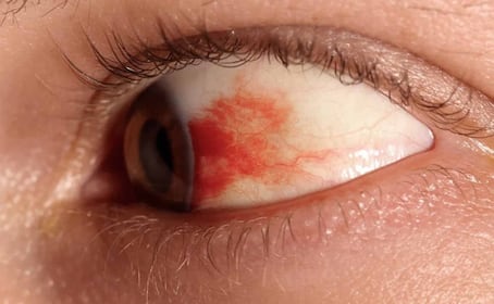 UNAM desarrolla gotas contra la ceguera por diabetes