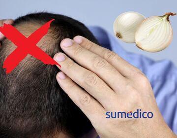 ¿Adiós a la calvicie gracias a la cebolla? Un estudio encontró sorprendente hallazgo