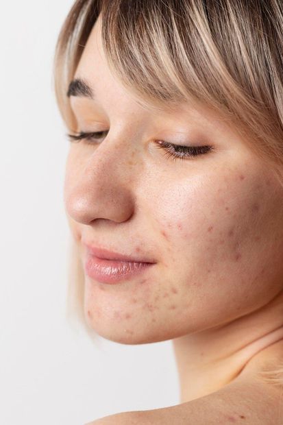 Lo ideal para evitar la aparición del acné es una buena higiene de piel. Fuente: Freepik.