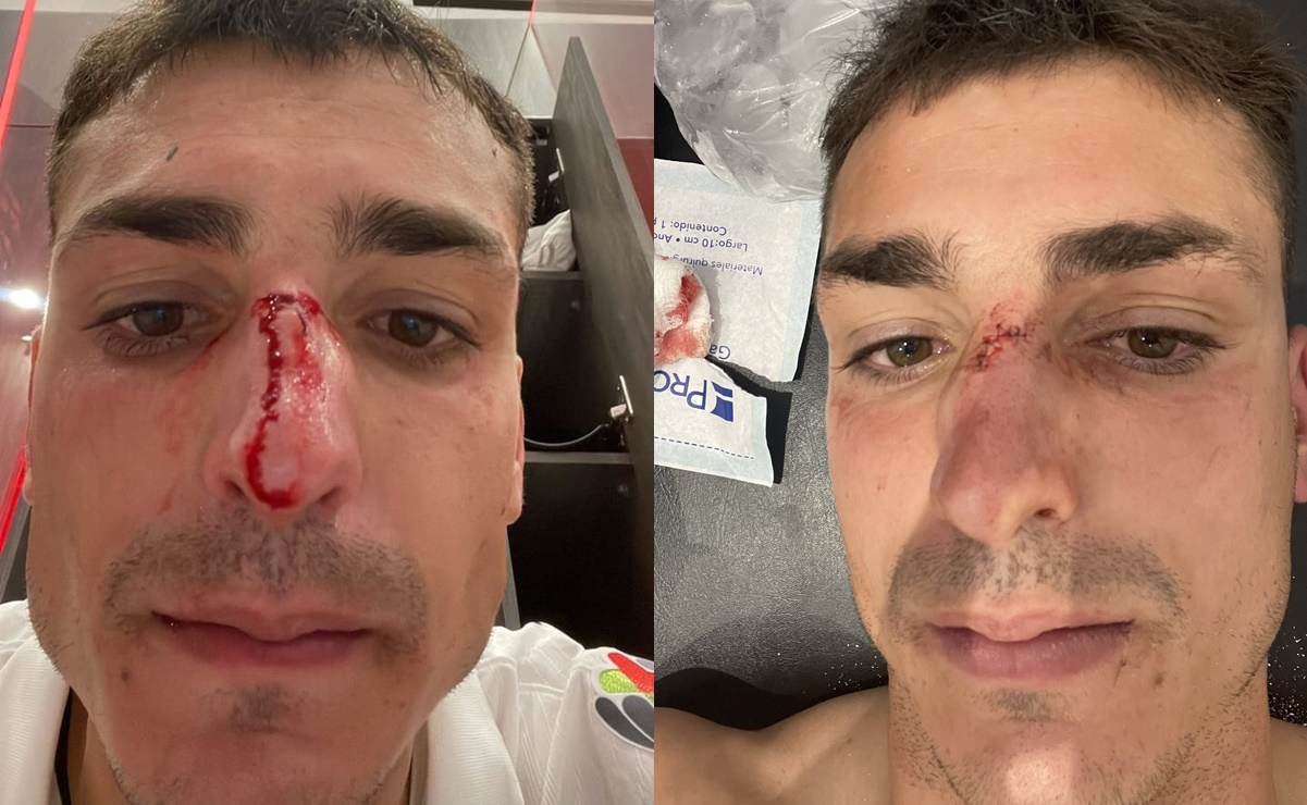 Juan Dinenno muestra su brutal fractura de nariz que sufrió contra el Atlas