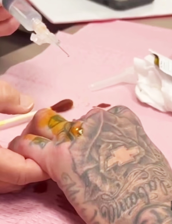 travis dedo - Travis Barker publica una foto de su fractura